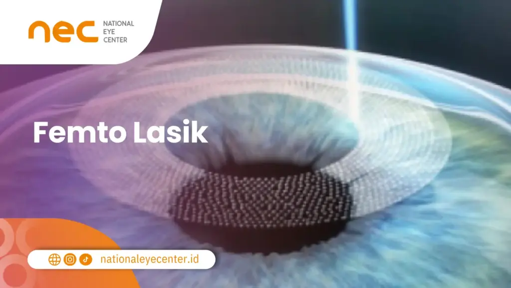 Femto Lasik