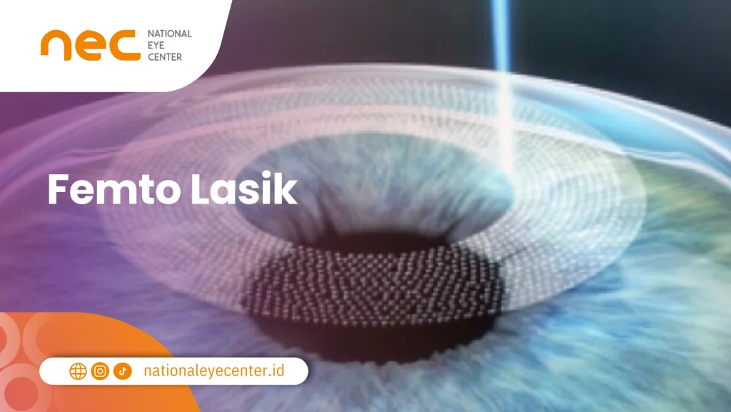 Femto Lasik