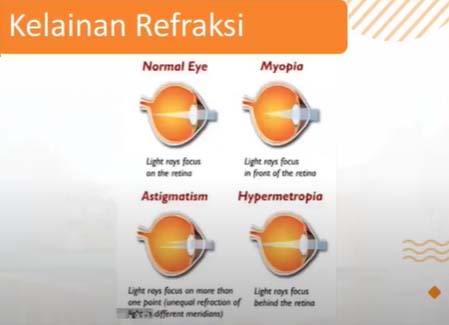kelainan refraksi butuh kacamata