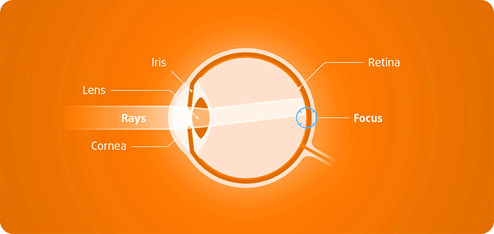 Silinder (Astigmatism)