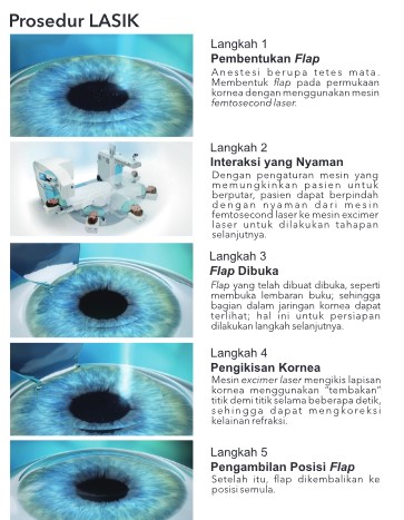 femto lasik