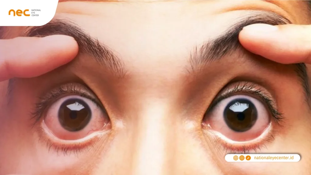 Cara Mengobati Sindrom Mata Kering Cara Mengobati Sindrom Mata Kering