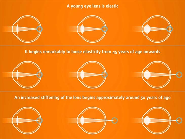presbiopi