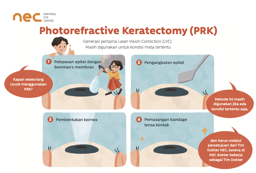 Gambar Prosedur PRK / lasik di NEC surabaya
