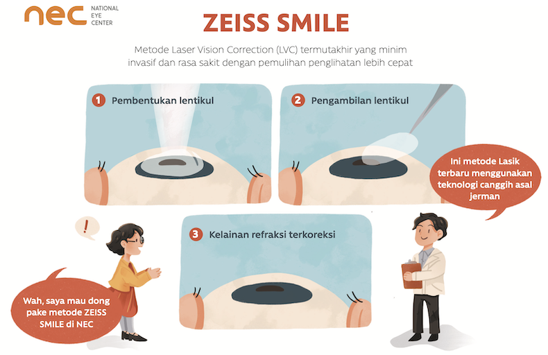 zeiss smile , metode lasik tercanggih saat ini