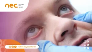 Cara Mengobati Ektropion