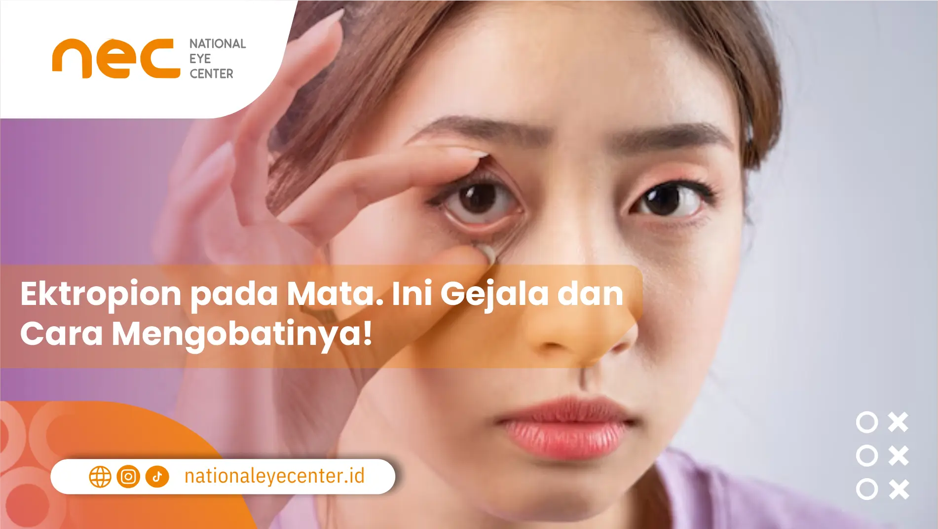 Ektropion pada Mata. Ini Gejala dan Cara Mengobatinya!