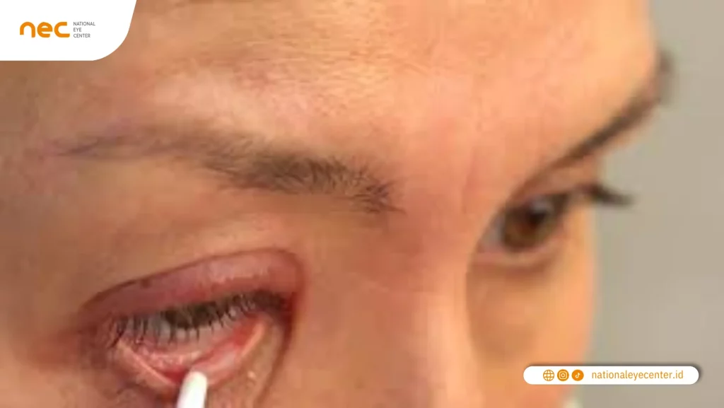 Pengobatan Tanpa Operasi pada Entropion Pengobatan Tanpa Operasi pada Entropion