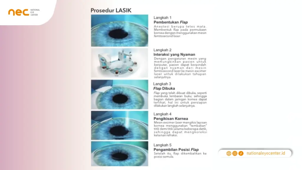 Prosedur LASIK Prosedur LASIK