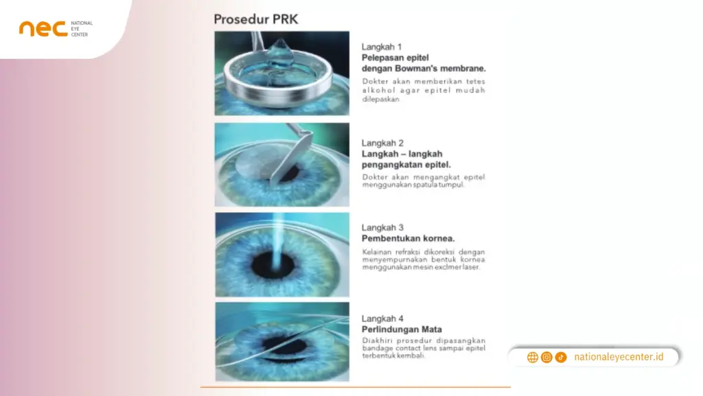 Prosedur PRK Prosedur PRK