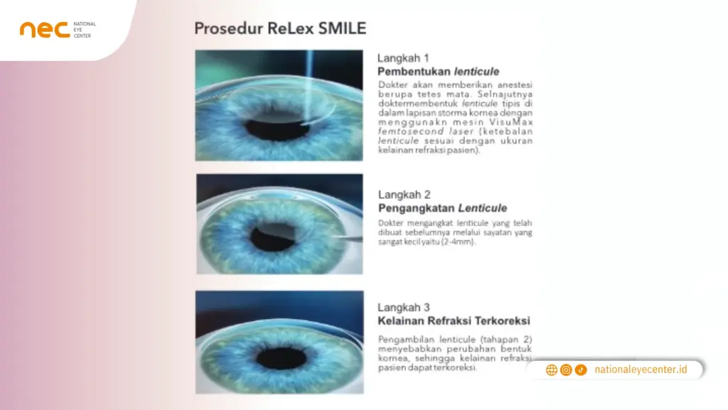Prosedur ReLex SMILE Prosedur ReLex SMILE