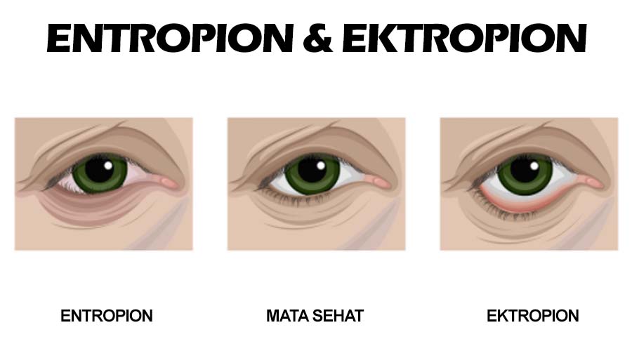 ektropion