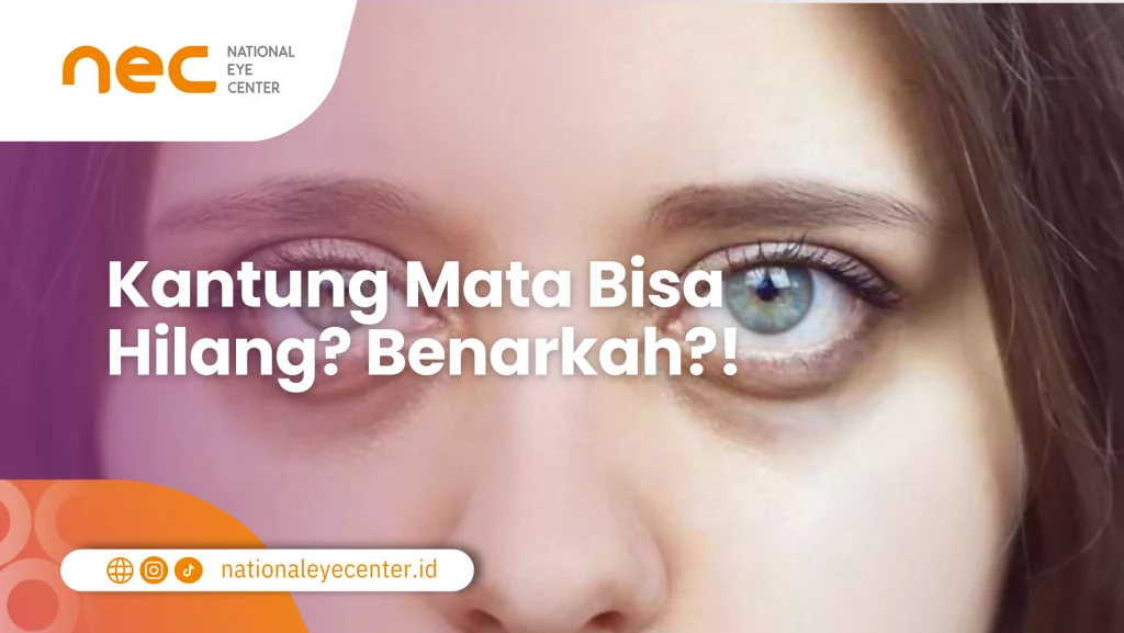 Benarkah katung mata bisa hilang