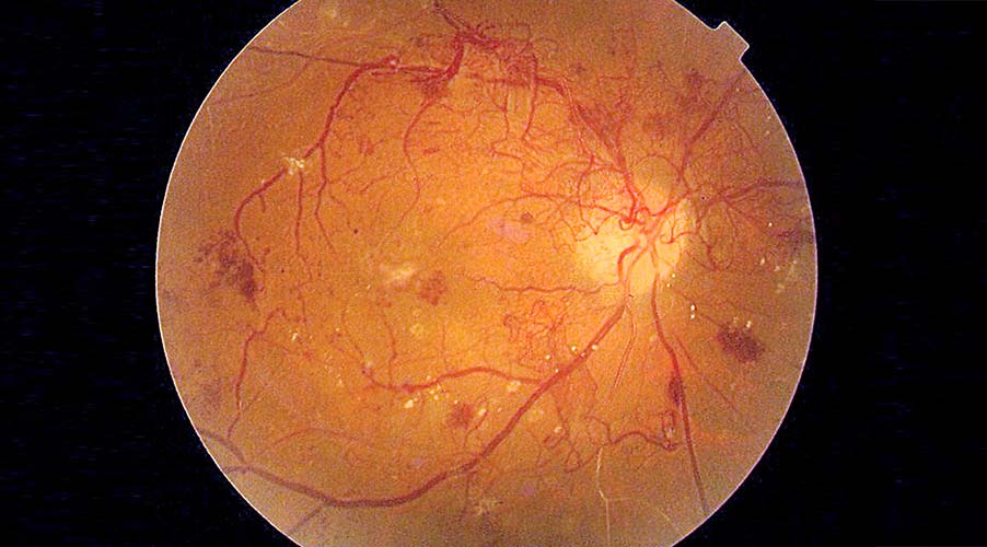 retinopati