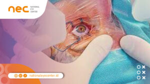 Batas Usia LASIK, Minimal Berapa Tahun dan Maksimal Berapa