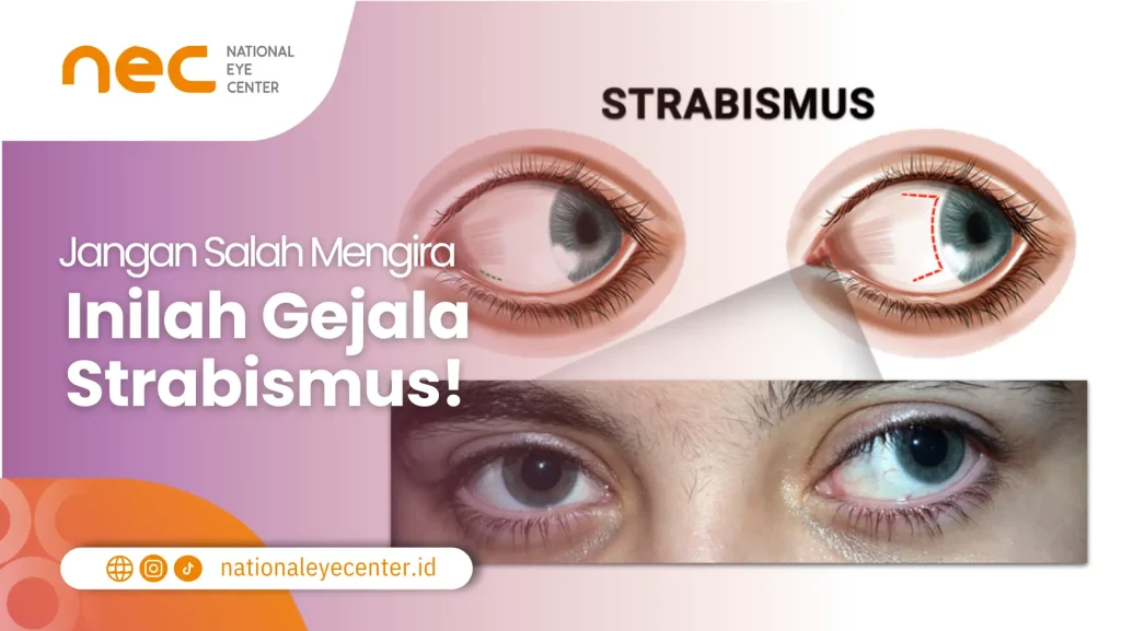 Macam-Macam Gejala Strabismus