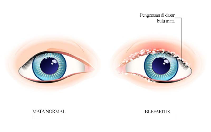 blefaritis