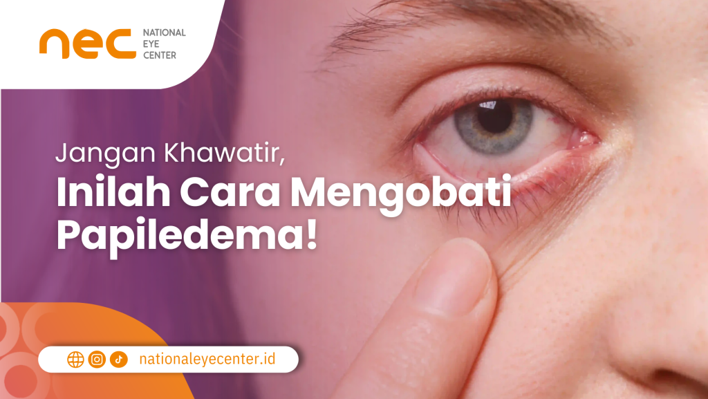 Cara Mengobati Papiledema