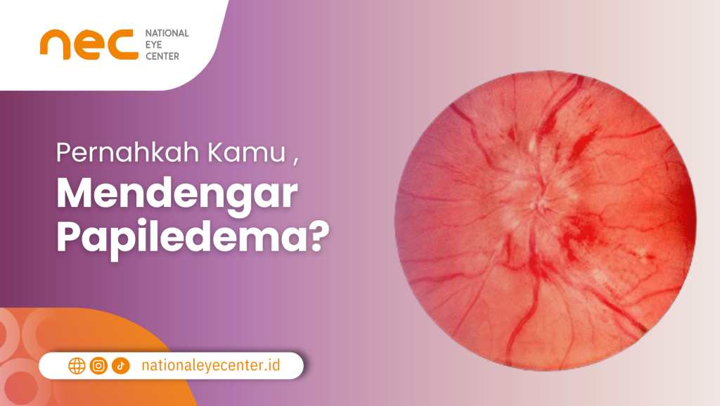 Definisi Papiledema