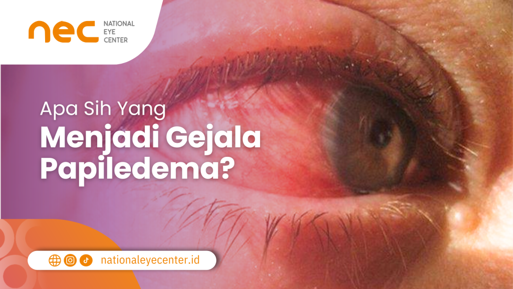 Gejala Papiledema