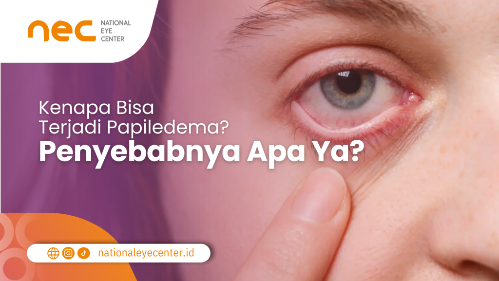 Penyebab Papiledema