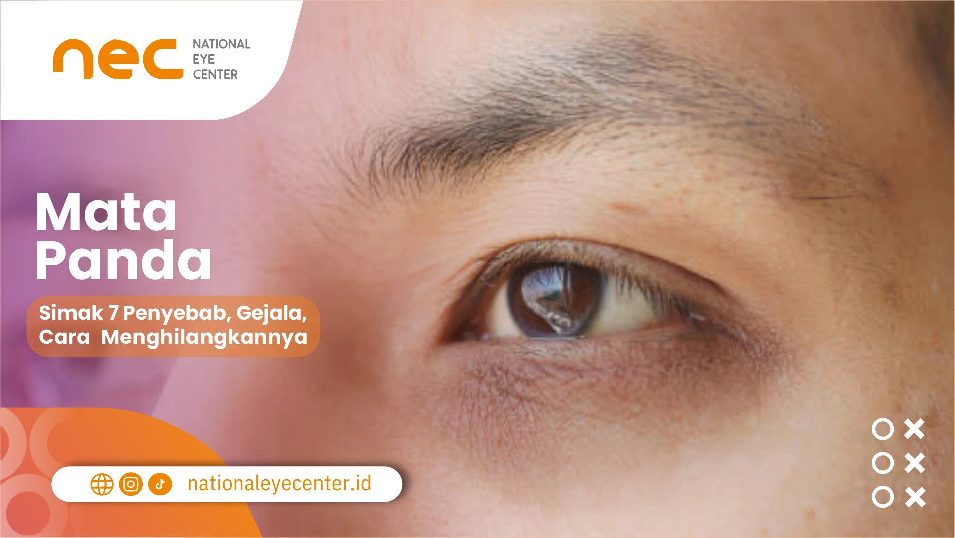 Mata Panda: Simak 7 Penyebab, Gejala, Cara Menghilangkannya