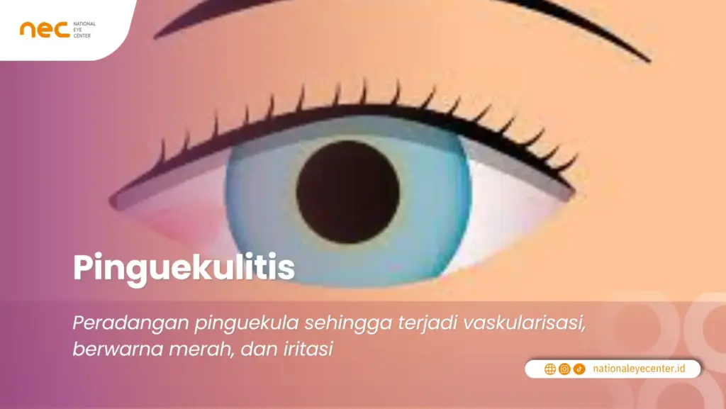 Pengertian Pinguekulitis