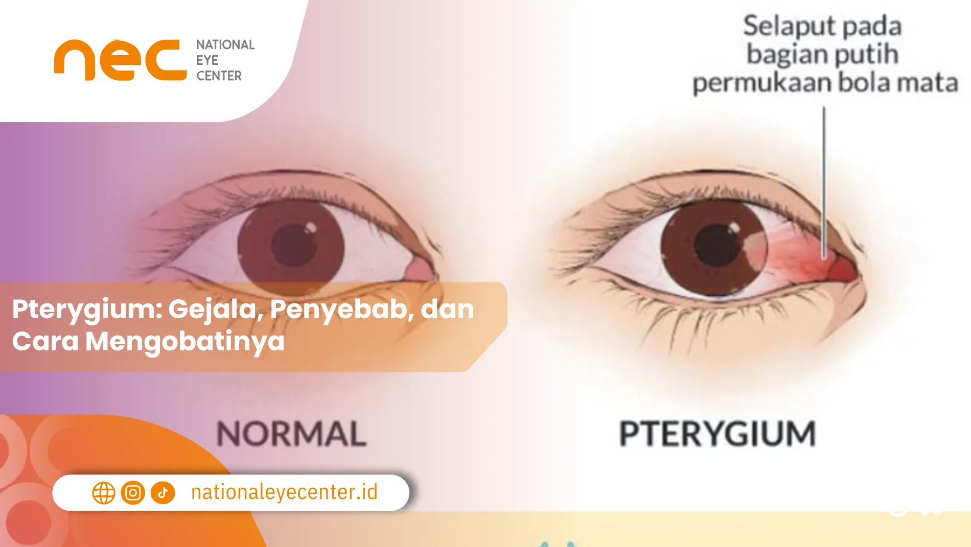 Pterygium: Gejala, Penyebab, dan Cara Mengobatinya