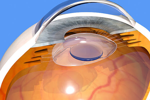  refractive lens exchange (RLE)