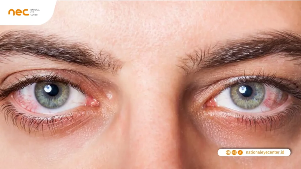 Pengertian Dry Eye atau Mata Kering Pengertian Dry Eye atau Mata Kering