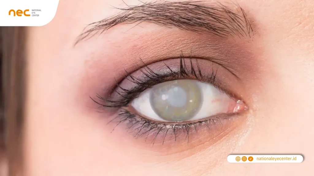 Cataract Awareness Month Cataract Awareness Month