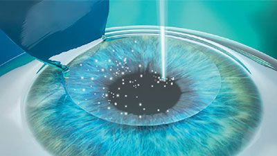 Perawatan Pasca Lasik