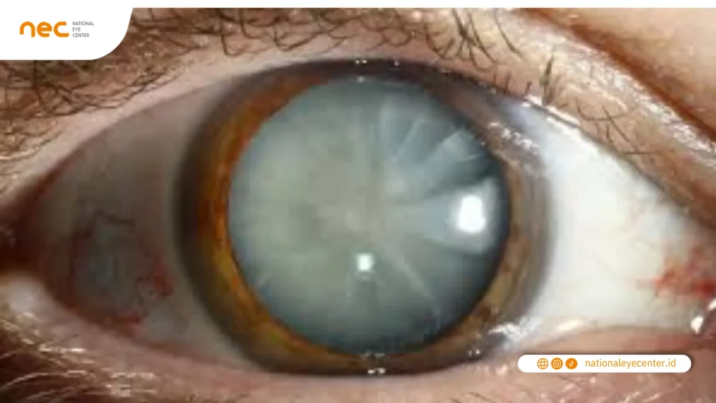 Fakta Katarak Fakta Katarak