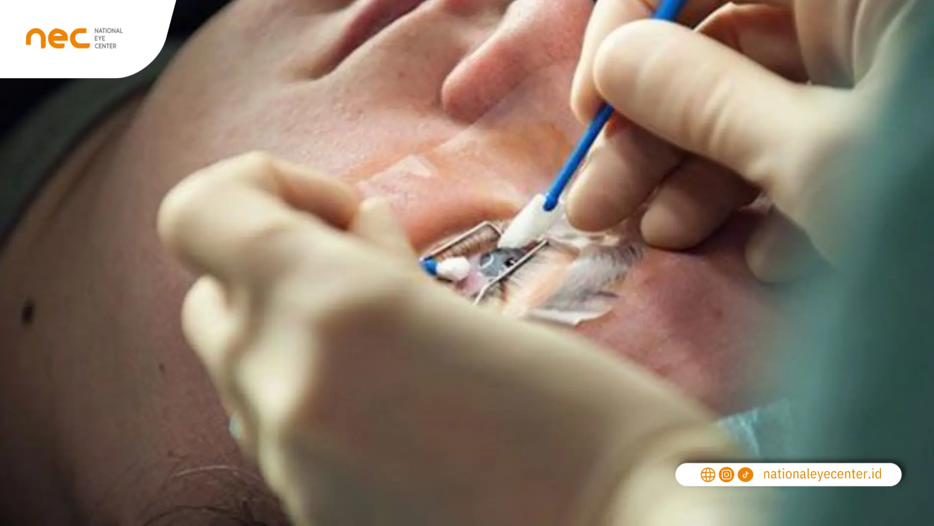 Sebab Mata Menjadi Kering Setelah Operasi Lasik