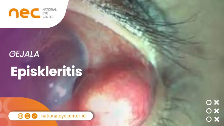 Gejala Episkleritis