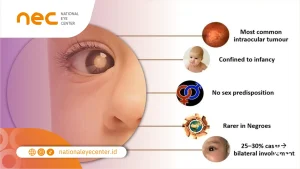 Kenali Retinoblastoma pada Anak