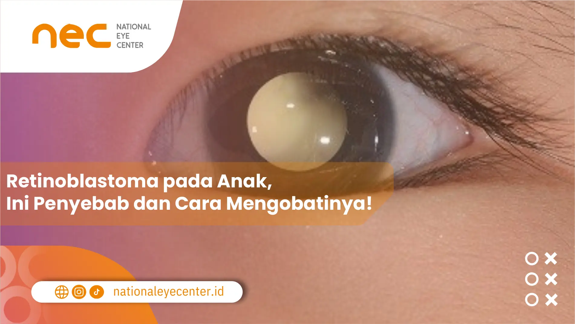 Retinoblastoma pada Anak. Ini Penyebab dan Cara Mengobatinya!