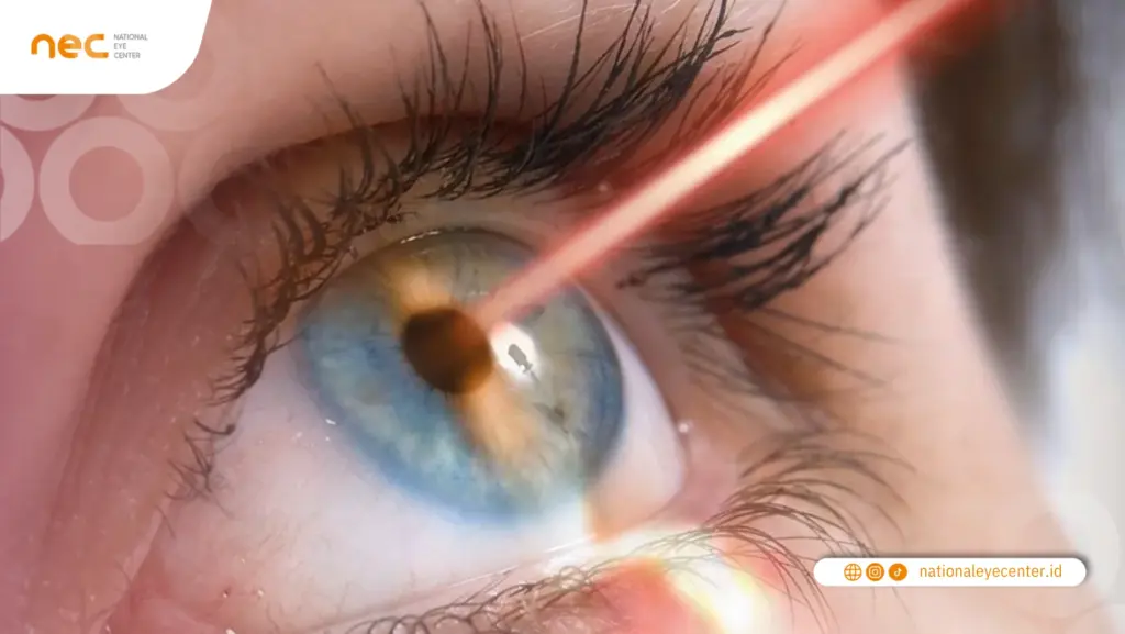 Alasan Kamu Butuh Lasik Mata