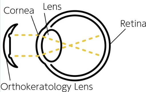 Operasi Mata Minus : Contoh