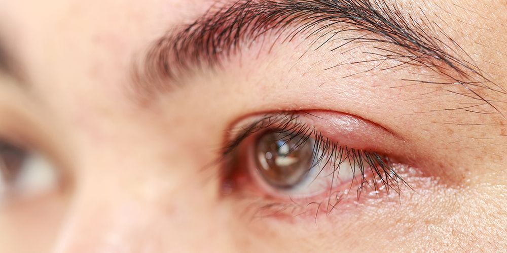 Mata Bintitan Sembuh Sendiri 