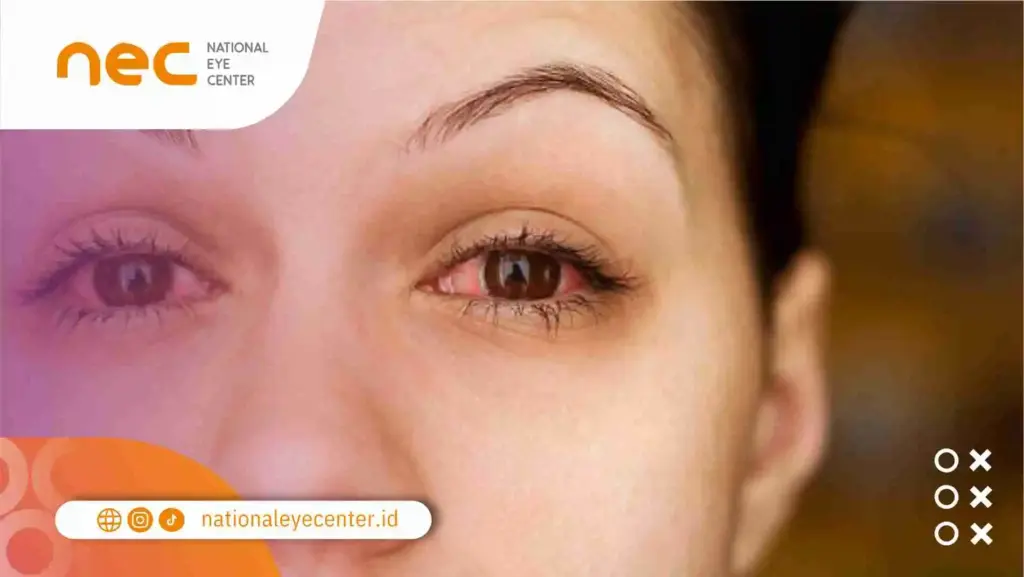 Risiko Penyakit Akibat Infeksi Karena Softlens