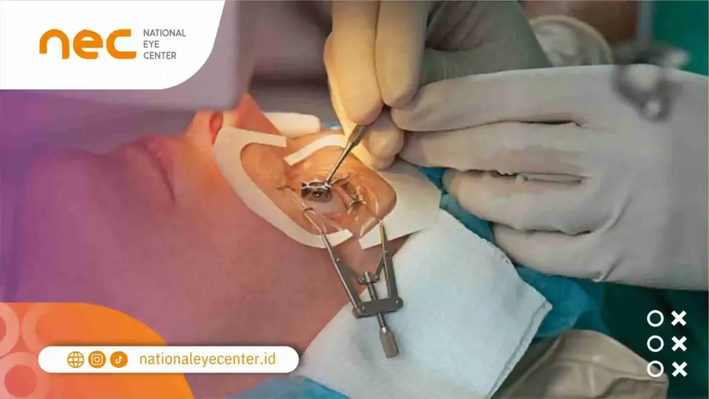 LASIK: SOLUSI TERBAIK UNTUK PENGLIHATAN ANDA, HENTIKAN INFEKSI KARENA SOFTLENS SEKARANG!