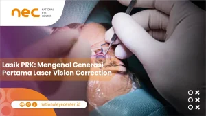 Lasik PRK: Mengenal Generasi Pertama Laser Vision Correction