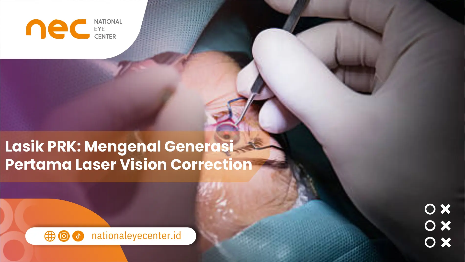 Lasik PRK: Mengenal Generasi Pertama Laser Vision Correction