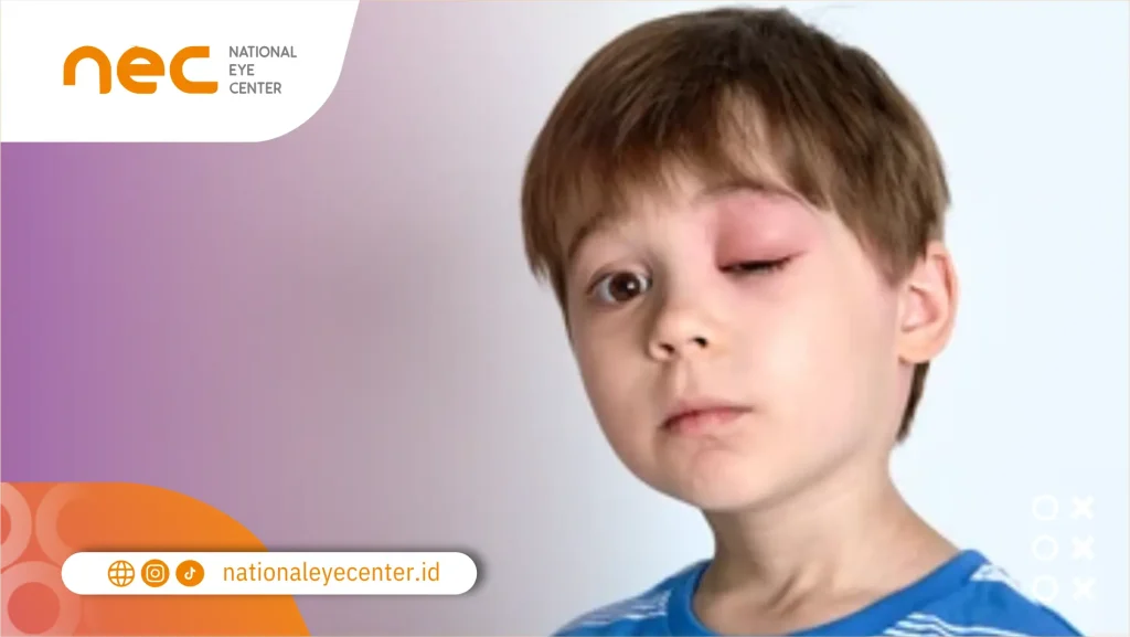 Mata Kelilipan Serangga Apakah Bahaya?