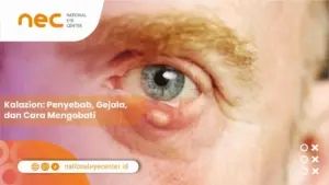 Kalazion: Penyebab, Gejala, dan Cara Mengobati