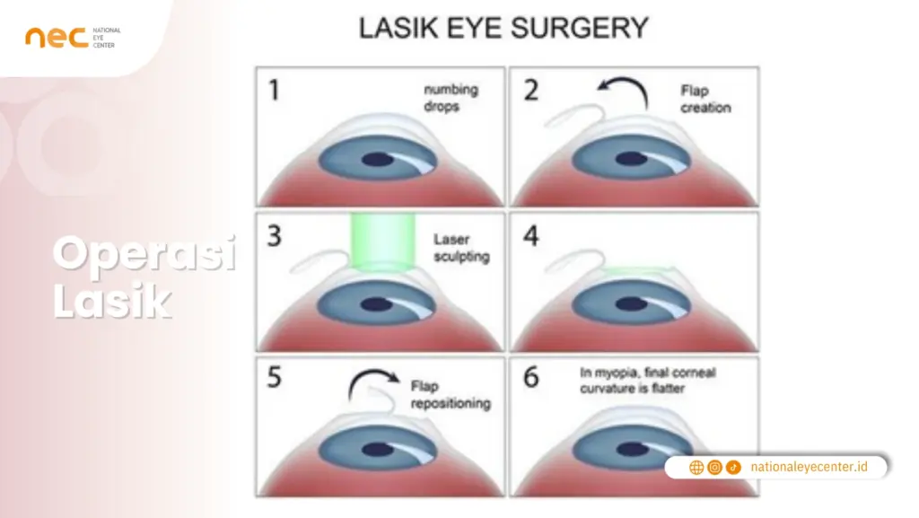 Lasik