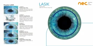 Lasik Berisiko! Perhatikan Hal-Hal Ini Agar Lasik Tetap Aman & Nyaman