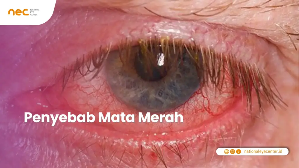 Penyebab Mata Merah