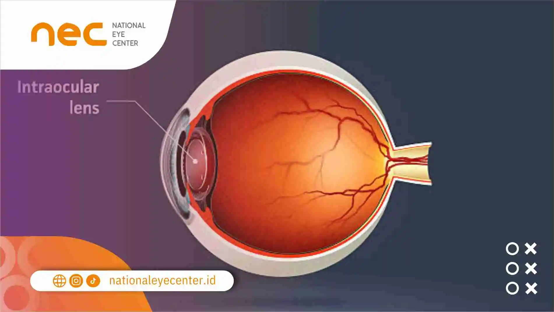 Phakic IOL Sebagai Pengobatan Selain LASIK!